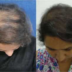 CARBOXYTHERAPIE : un traitement de la chute de cheveux